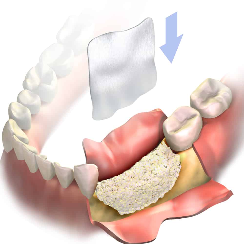 Bone graft / sinus lift – implant & periodontal institute of torrance